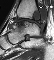 Ankle OA MRI